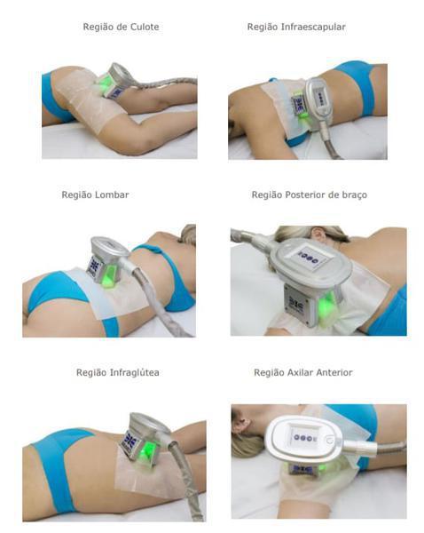Locação de Máquina de Criolipólise de Última Geração !!!!