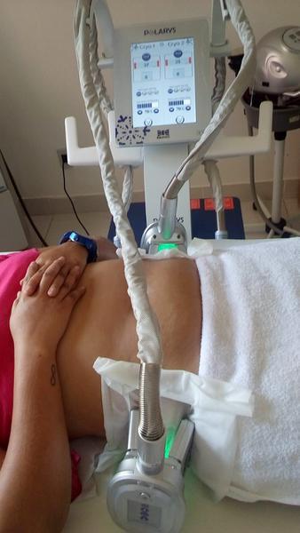 Locação de Máquina de Criolipólise de Última Geração !!!!